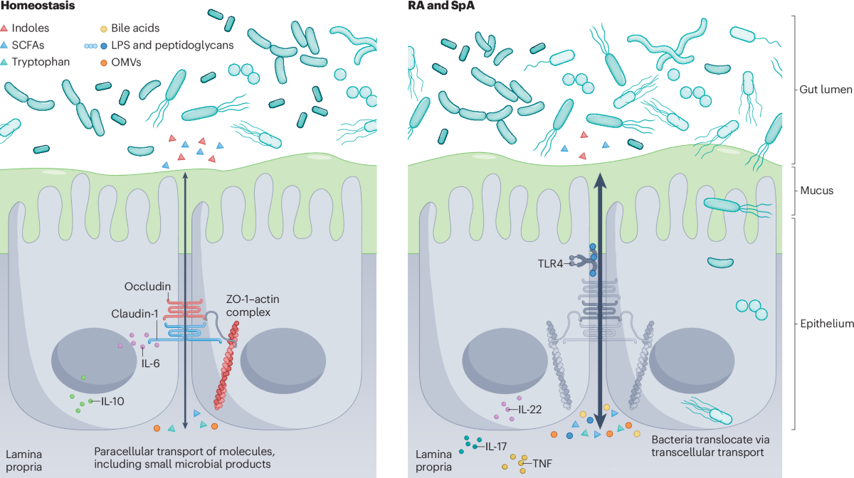 leaky gut glutathione More than a leaky gut: how gut priming shapes arthritis