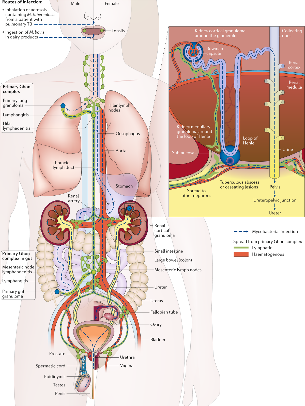 Urogenital tuberculosis — epidemiology, pathogenesis and clinical features  | Nature Reviews Urology, image size:1200x1594
