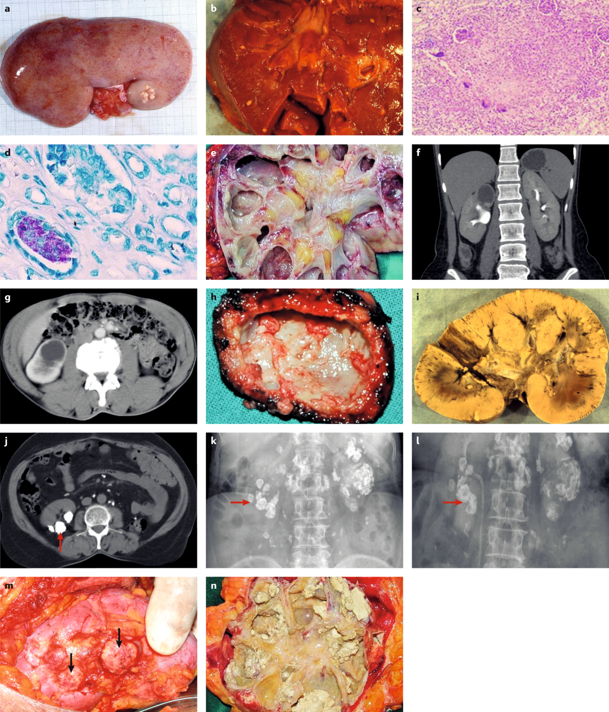 Urogenital tuberculosis — epidemiology, pathogenesis and clinical features  | Nature Reviews Urology, image size:1200x1403