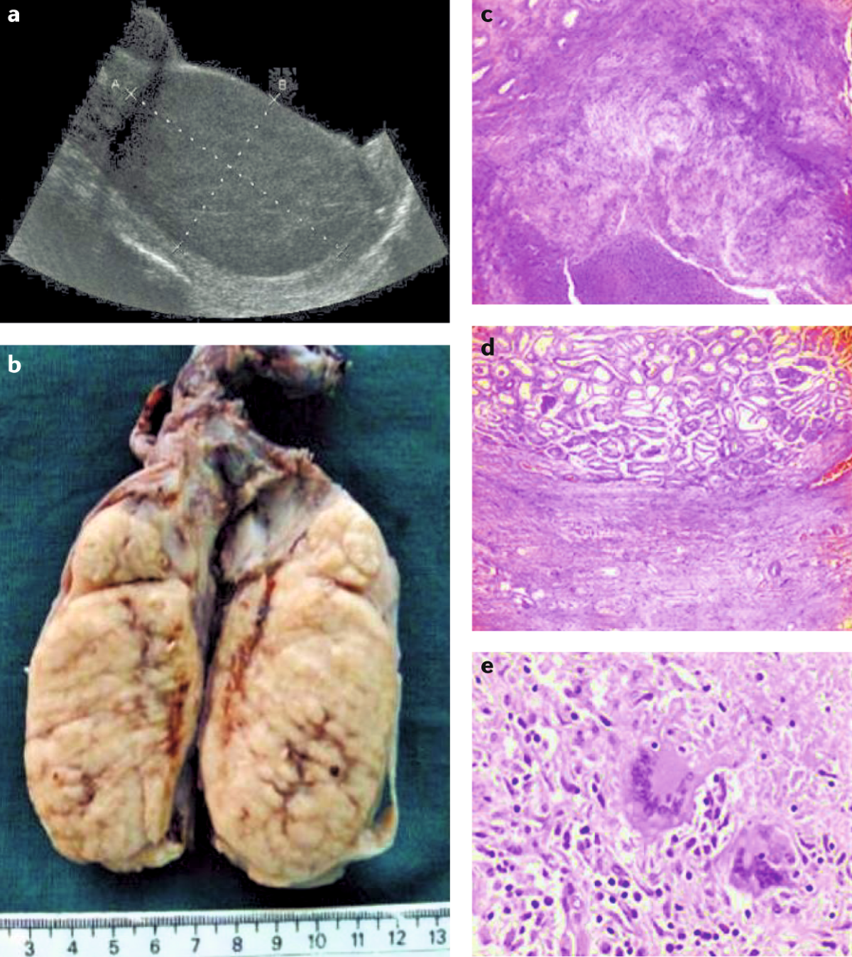 Tuberculosis (TB) Guide | Advocate Health Care, image size:1200x1347