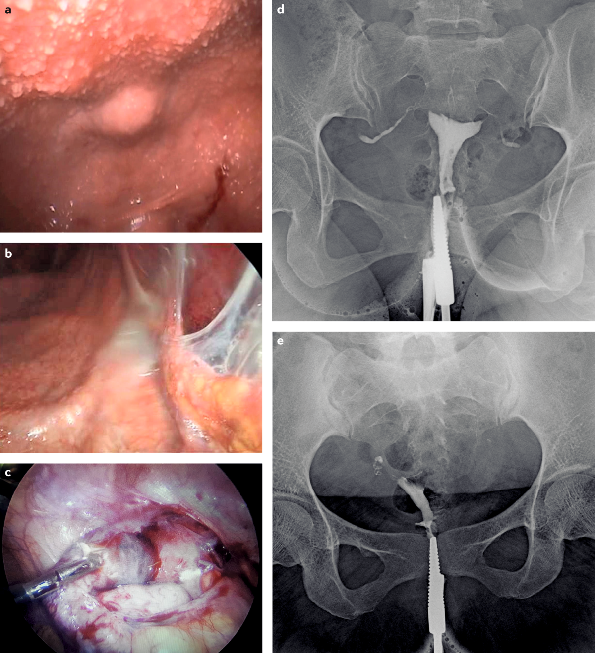 Urogenital tuberculosis — epidemiology, pathogenesis and clinical features  | Nature Reviews Urology, image size:1200x1318