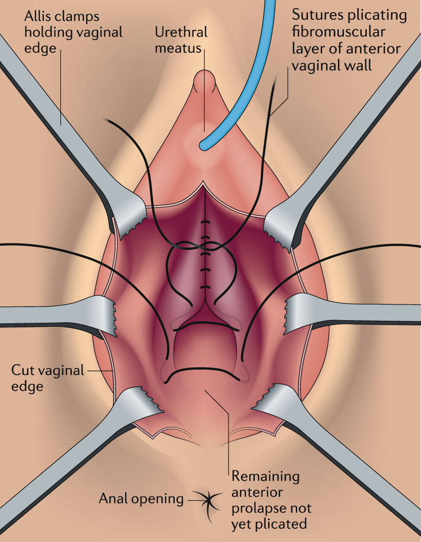 Pelvic organ prolapse and sexual function | Nature Reviews Urology, image size:831x1068