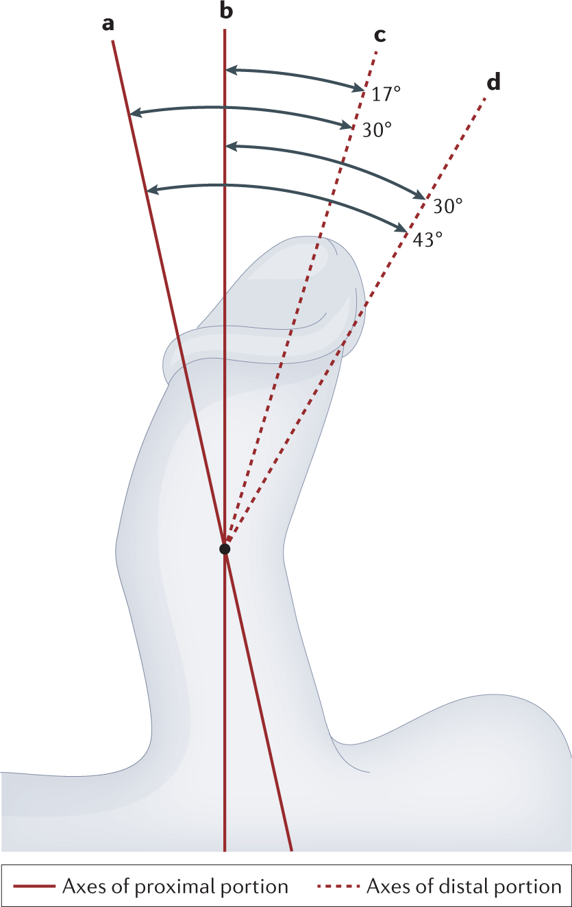 The History of Hypospadias and Hypospadias Repairs - Urology, image size:835x1323