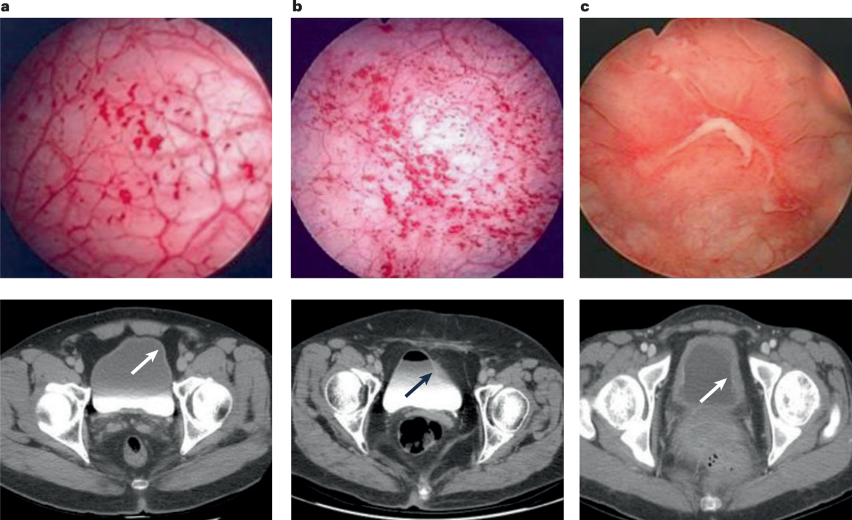 Pathophysiology and potential multimodal therapeutic strategies for IC/BPS