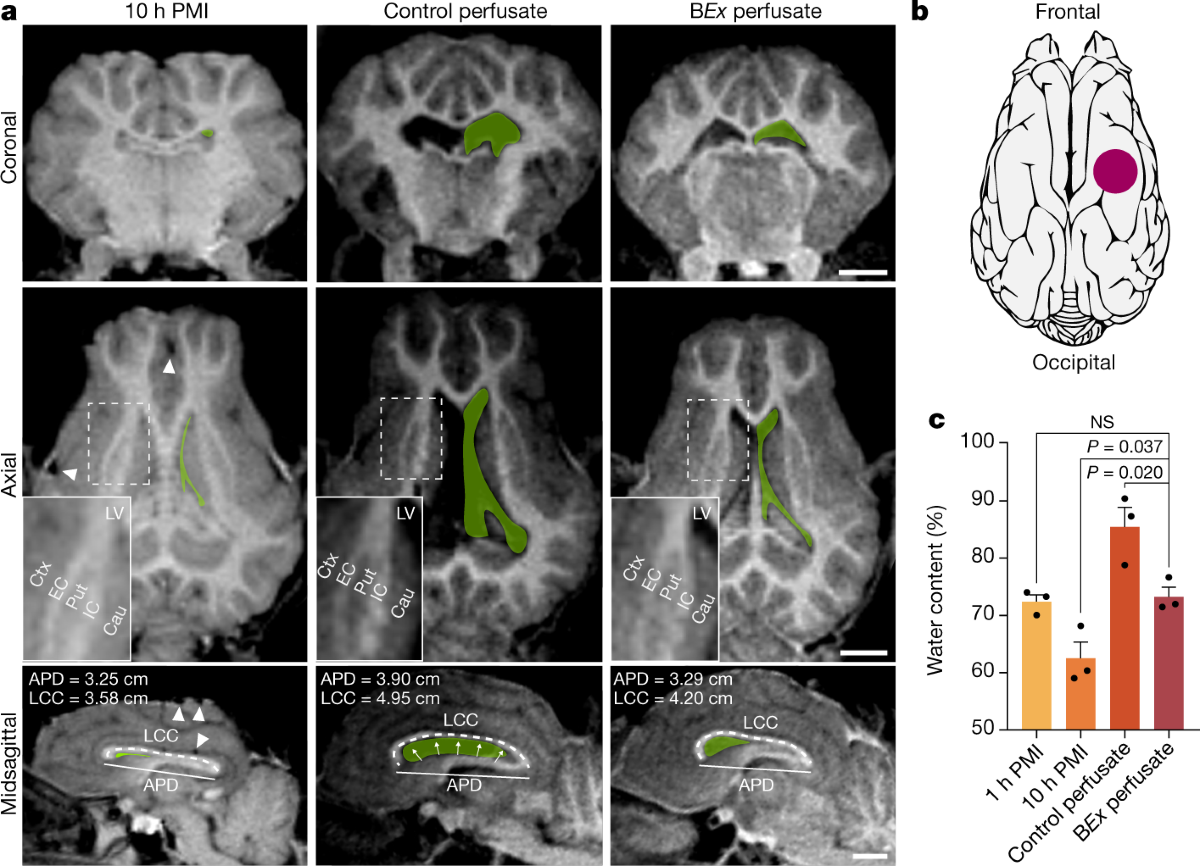 Restoration of brain circulation and cellular functions hours post-mortem |  Nature