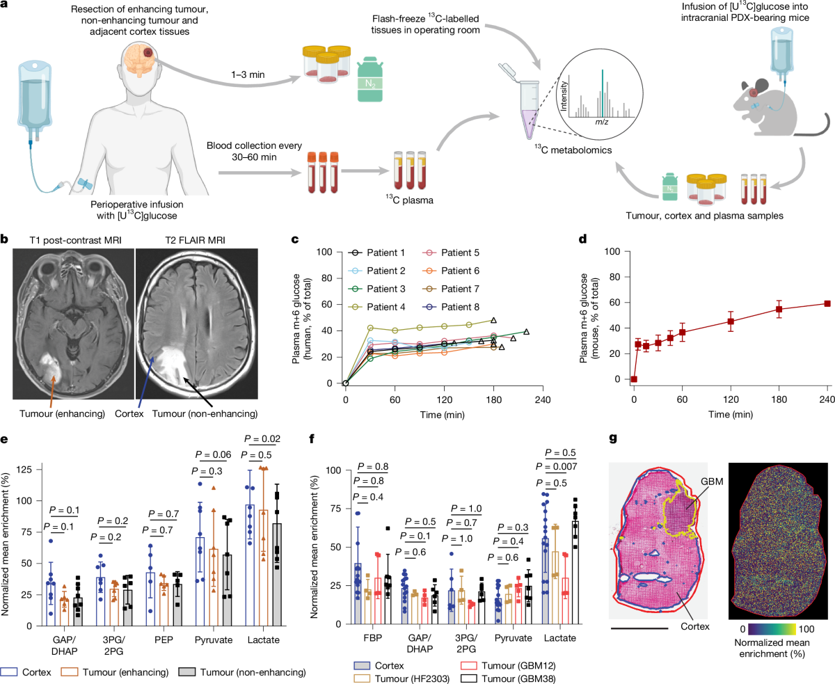 Rewiring of cortical glucose metabolism fuels human brain cancer growth |  Nature