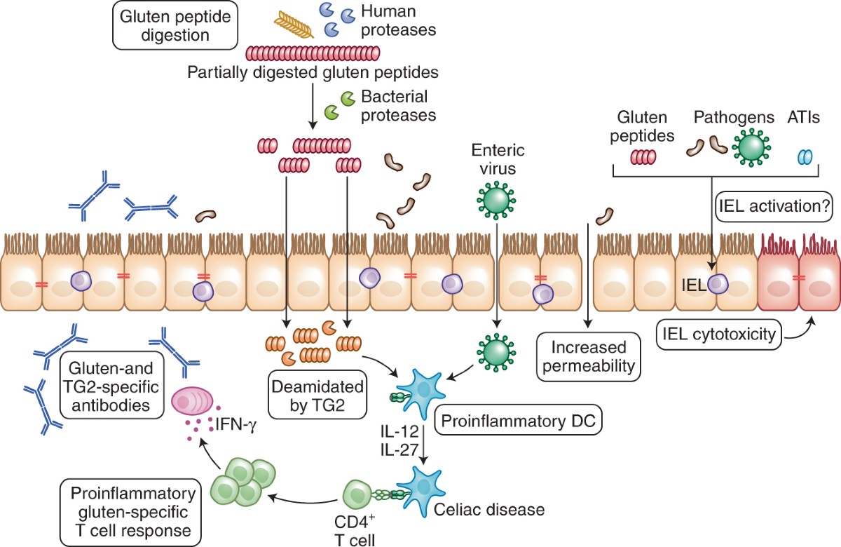 Common ground shared risk factors for type 20 diabetes and celiac ...