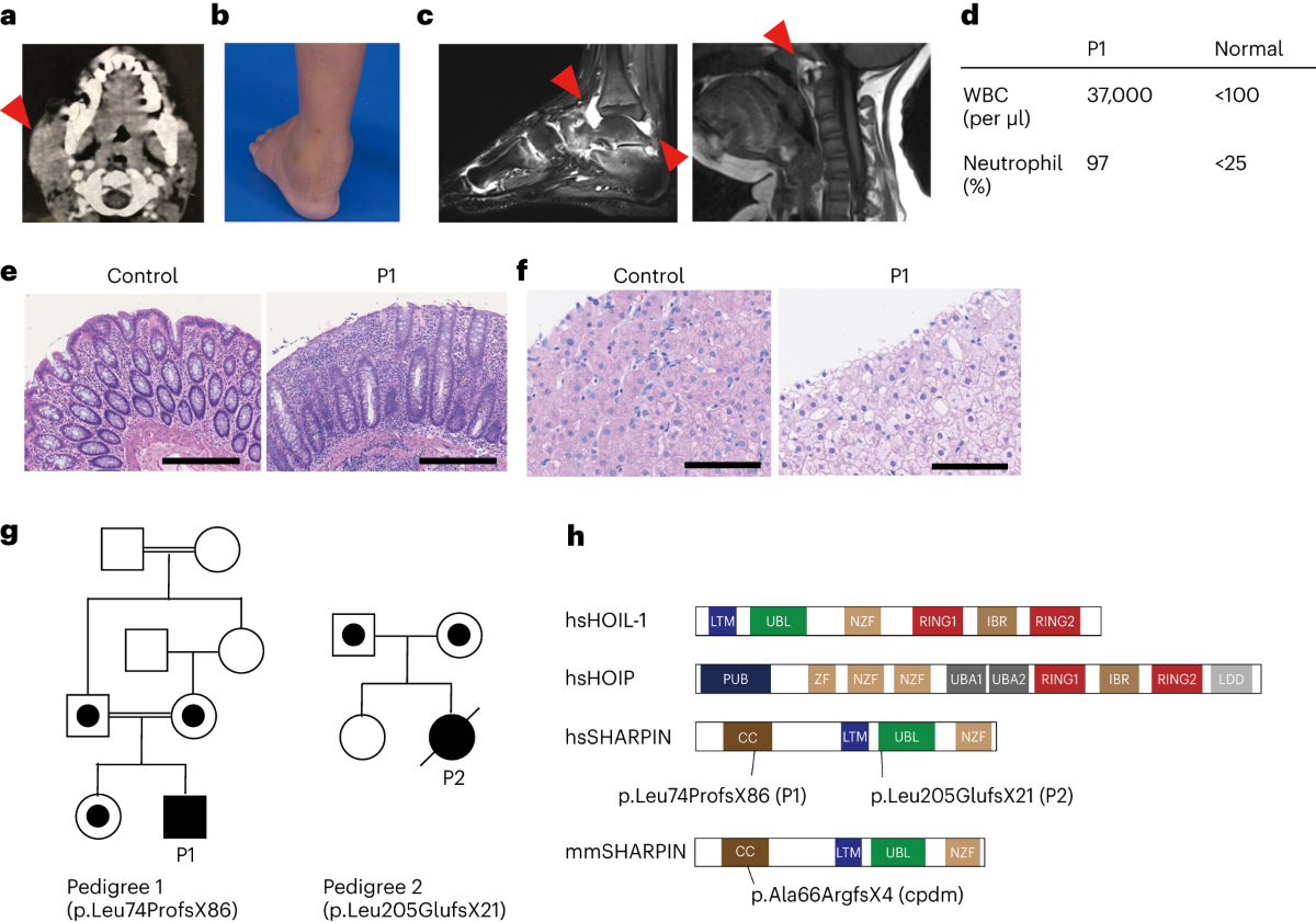 Biallelic human SHARPIN loss of function induces autoinflammation and  immunodeficiency | Nature Immunology
