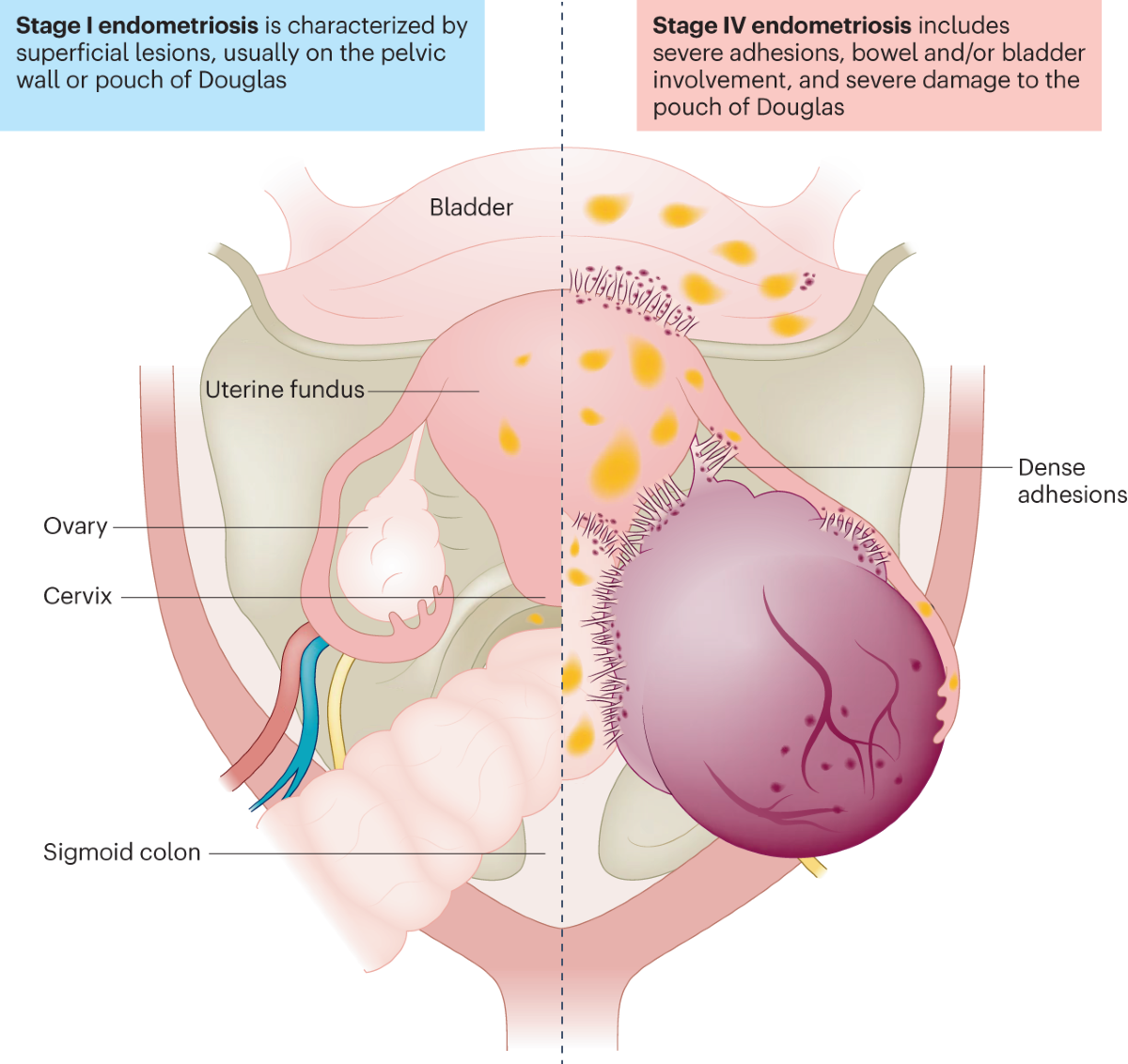 Surge in endometriosis research after decades of underfunding 