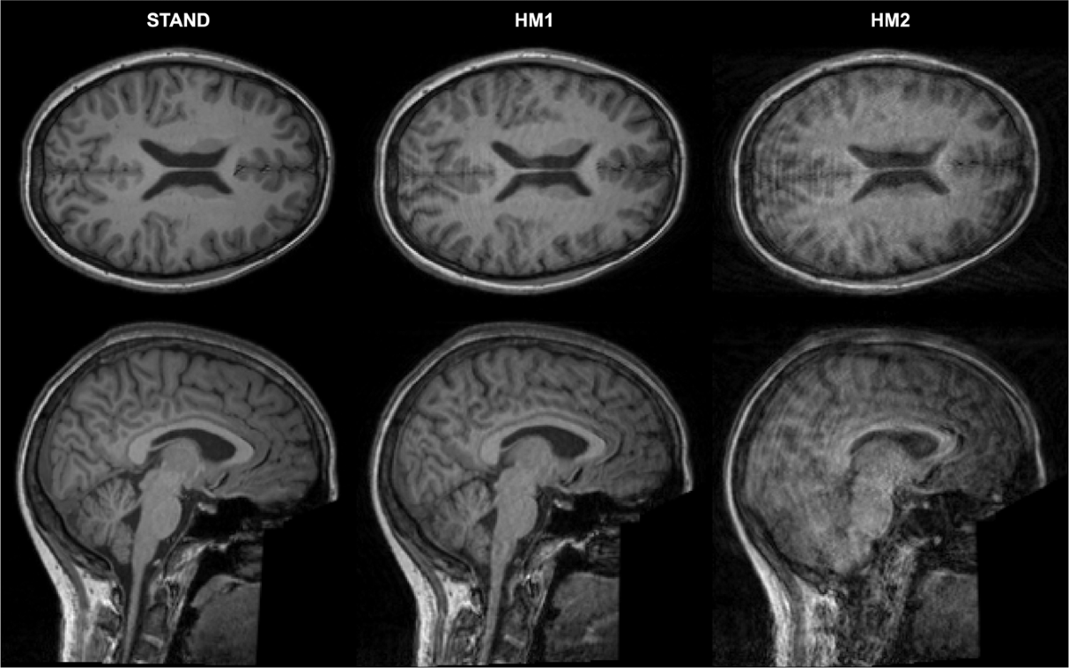 Movement-related artefacts (MR-ART) dataset of matched motion-corrupted and clean structural MRI brain scans | Scientific Data