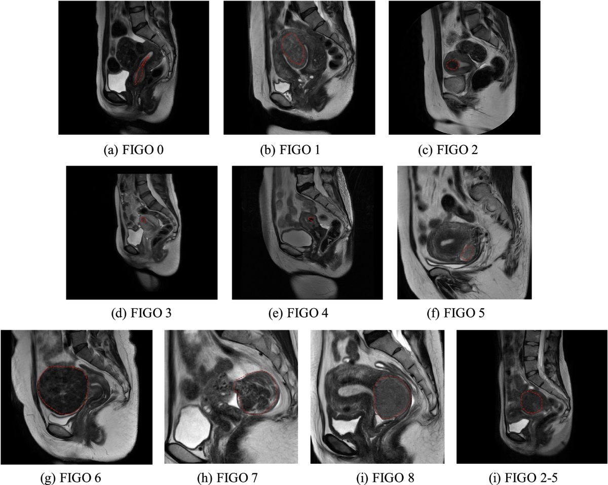 The epidemiology and pathogenesis of uterine fibroids - Munro - 2025 -  International Journal of Gynecology \u0026 Obstetrics - Wiley Online Library, image size:1200x958