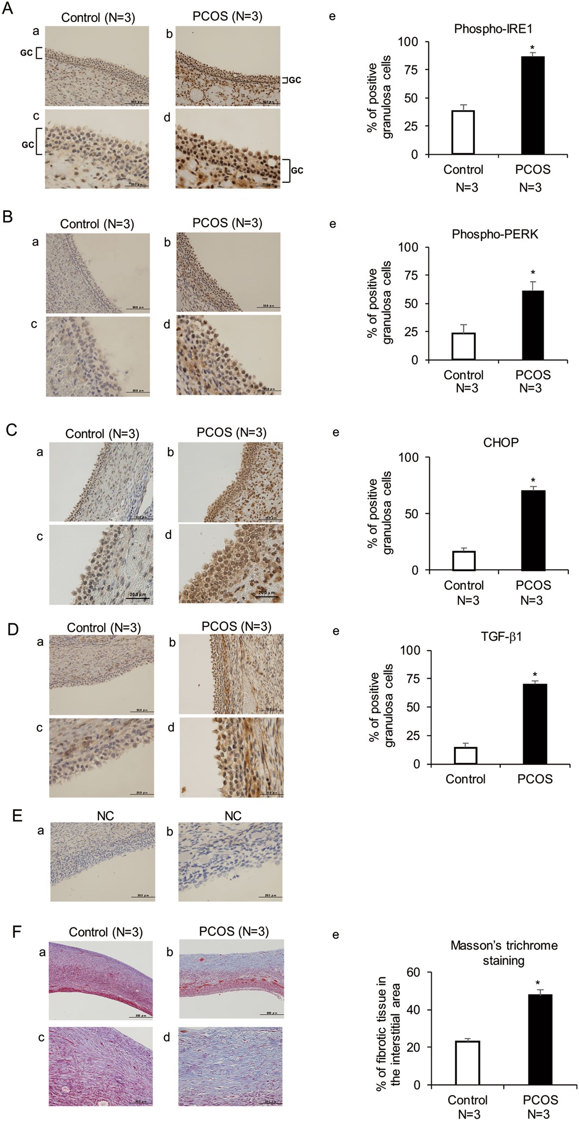 Activation of Endoplasmic Reticulum Stress in Granulosa Cells from Patients  with Polycystic Ovary Syndrome Contributes to Ovarian Fibrosis | Scientific  Reports