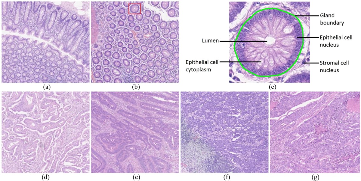 Glandular Morphometrics for Objective Grading of Colorectal Adenocarcinoma Histology Images | Scientific Reports