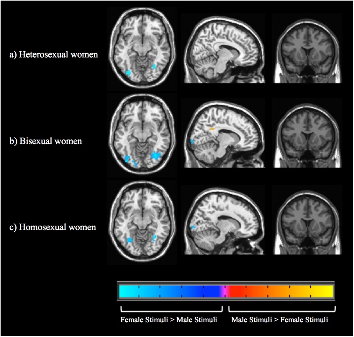 Neural Correlates of Sexual Orientation in Heterosexual, Bisexual, and  Homosexual Women | Scientific Reports