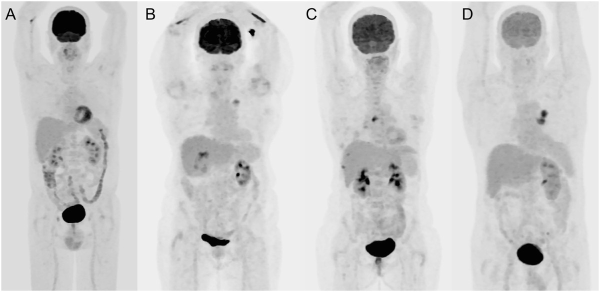 Does CT Contrast Affect Blood Sugar: Unveiling the Truth