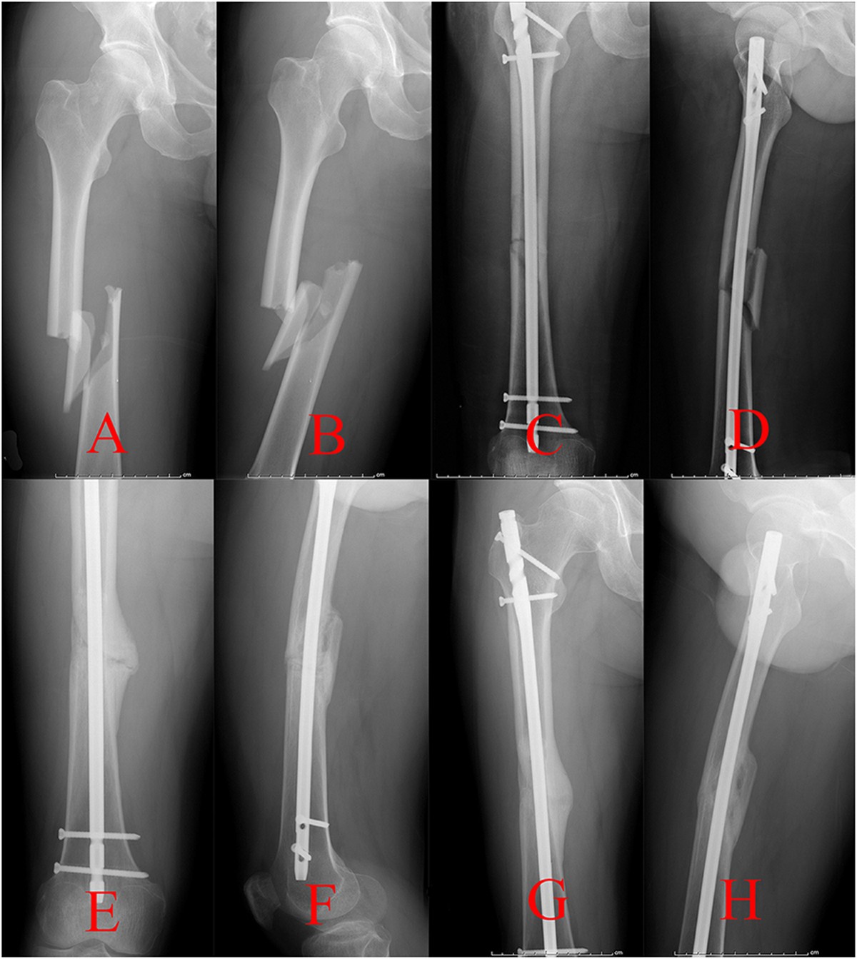 PDF) Antegrade Versus Retrograde Locked Intramedullary Nailing for Femoral  Fractures: Which Is Better? | Vivek A/L Ajit Singh - Academia.edu