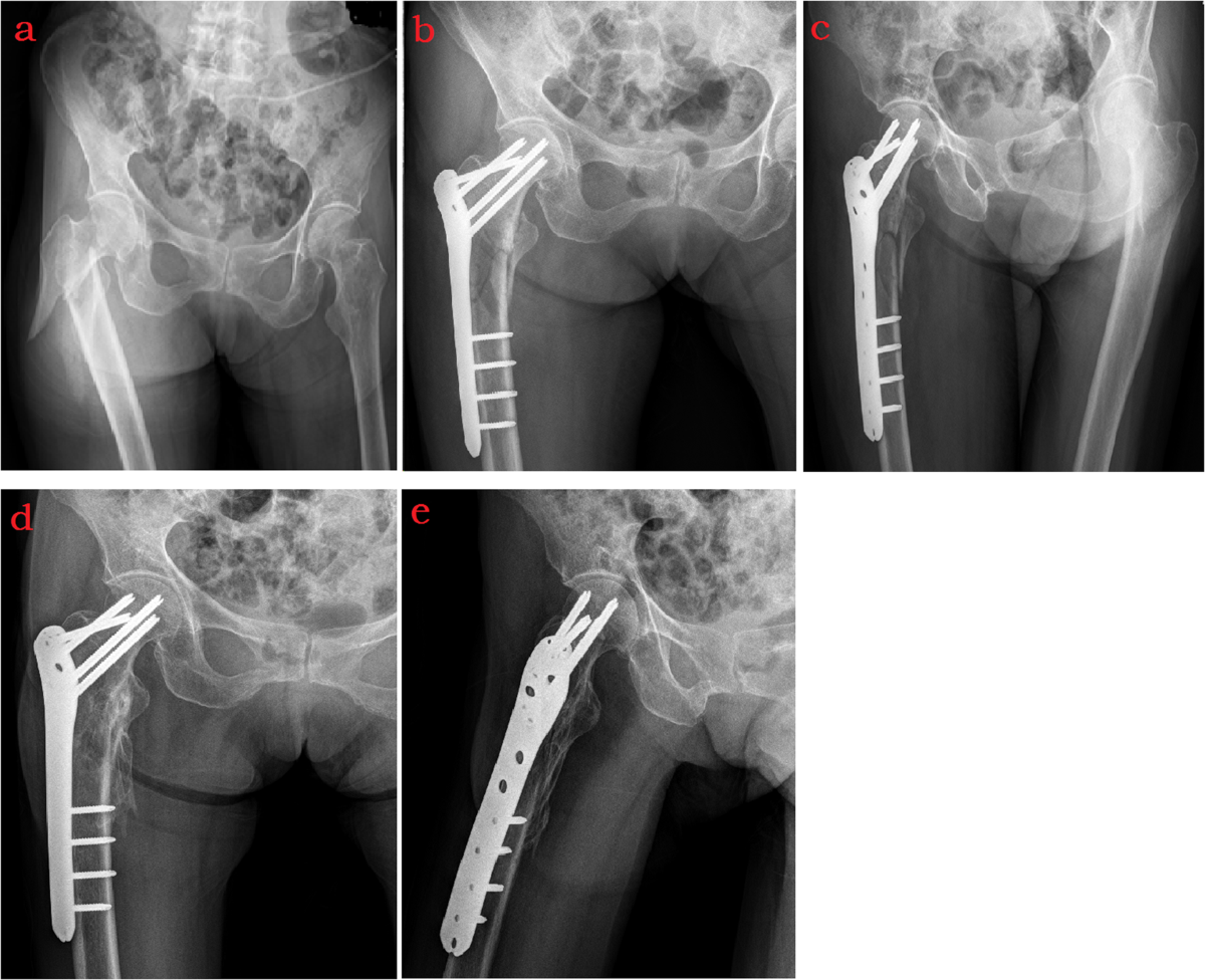 Controlled study on Gamma nail and proximal femoral locking plate for  unstable intertrochanteric femoral fractures with broken lateral wall |  Scientific Reports