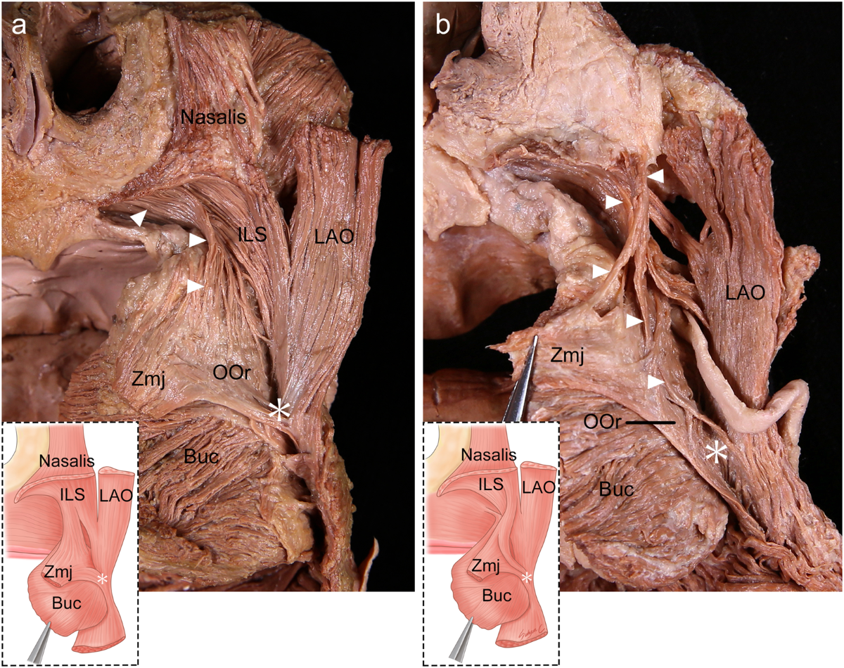 The Sub-Orbicularis Oris Fat of the Upper and Lower Lips (SFL): Anatomical  Observations and Clinical Correlations, image size:1200x950