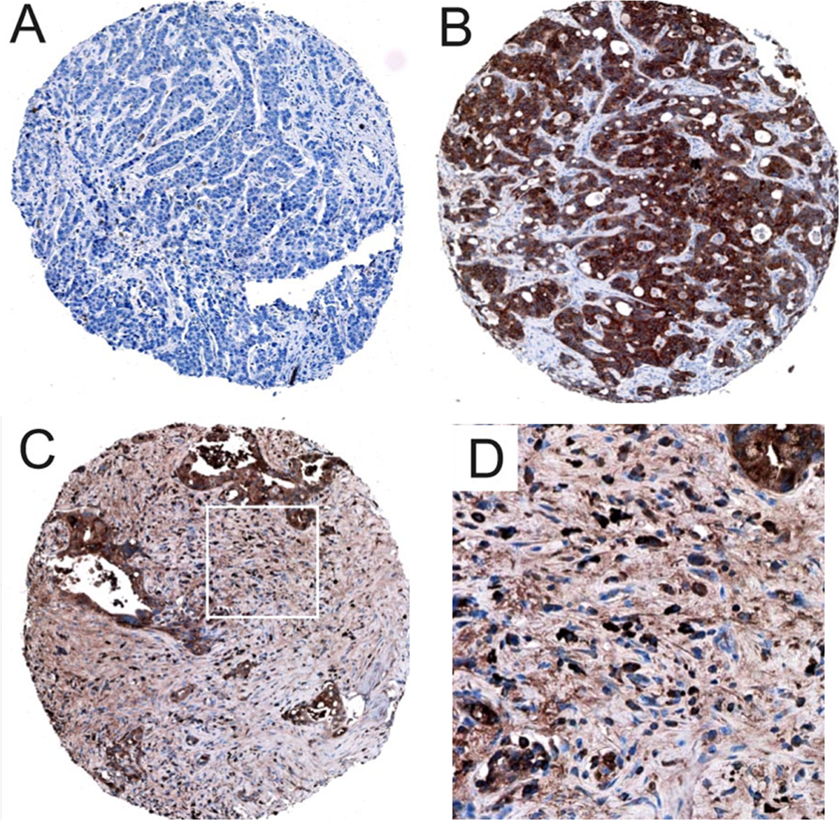 Prognostic Impact of Carboxylesterase 2 in Cholangiocarcinoma | Scientific  Reports