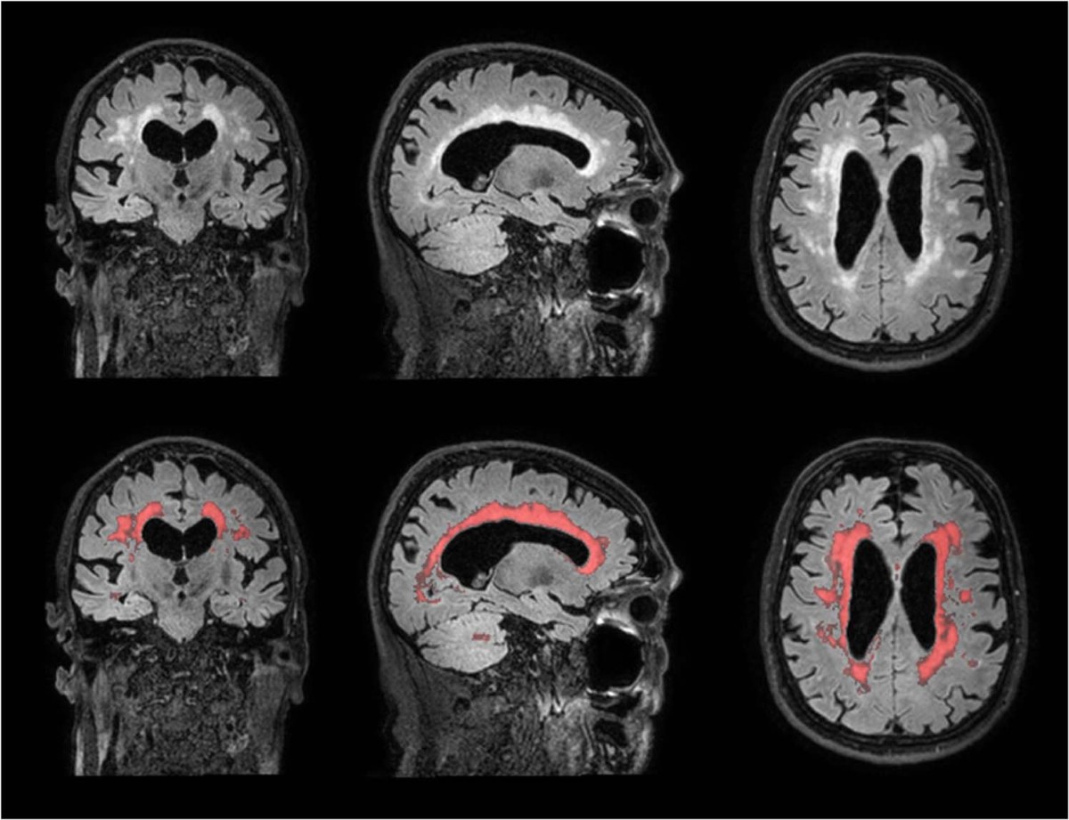 The association between frailty and MRI features of cerebral small vessel  disease | Scientific Reports