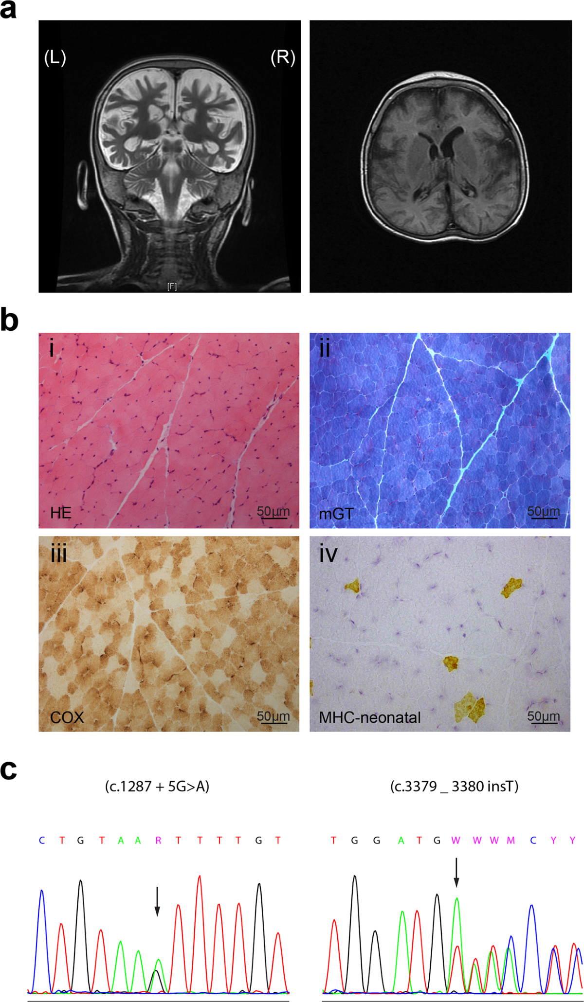 Characterization of three TRAPPC11 variants suggests a critical role for the  extreme carboxy terminus of the protein | Scientific Reports