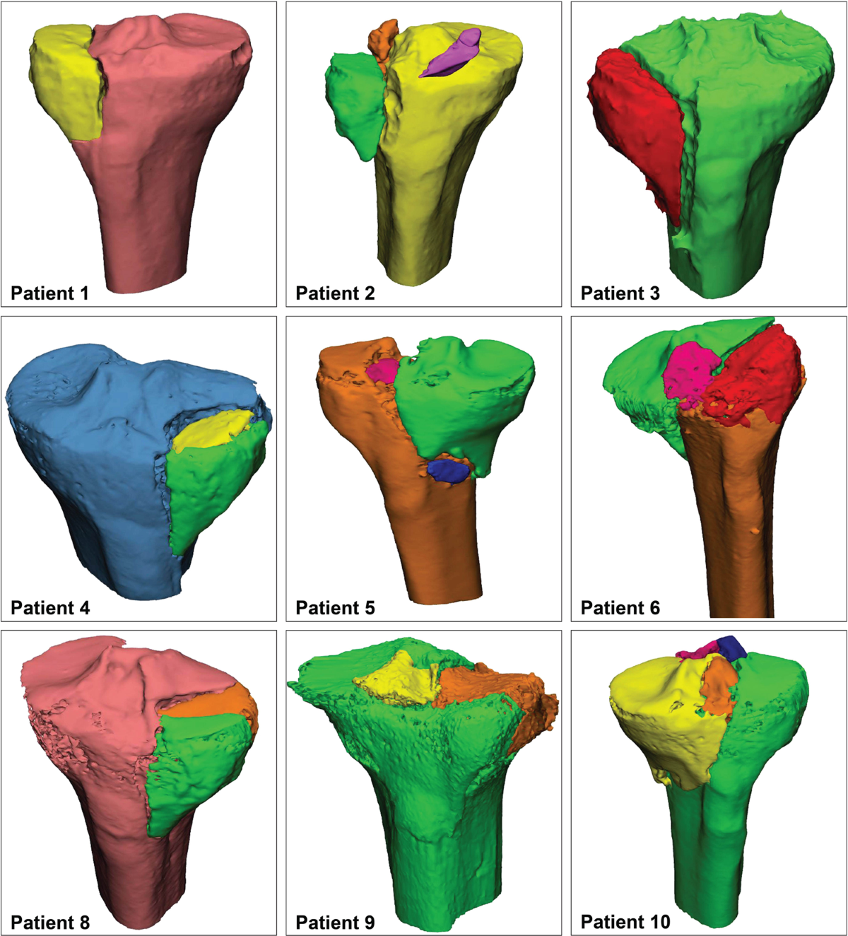 Quantitative 3D measurements of tibial plateau fractures | Scientific  Reports, image size:1200x1324