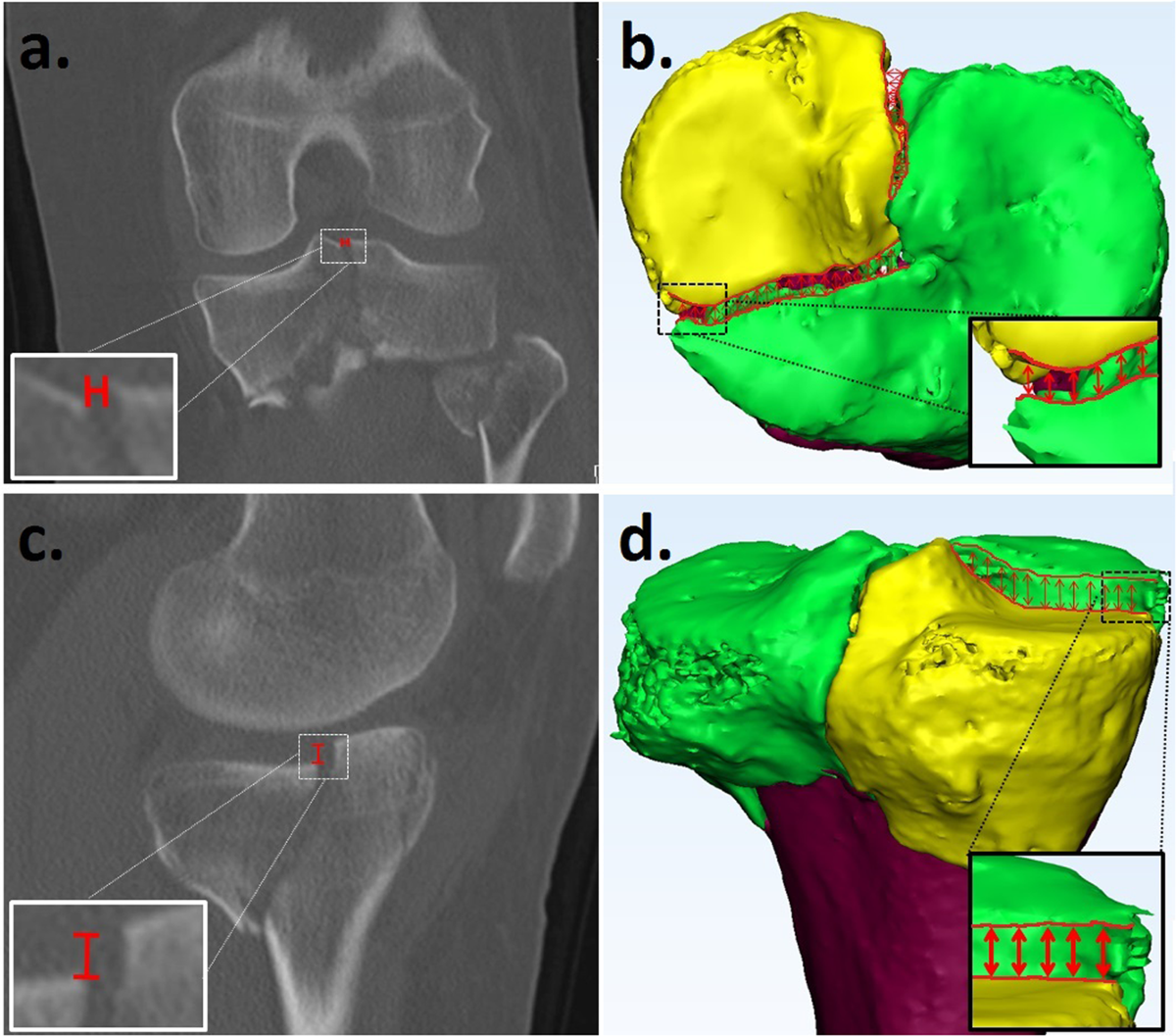 Quantitative 3D measurements of tibial plateau fractures | Scientific  Reports, image size:1200x1057
