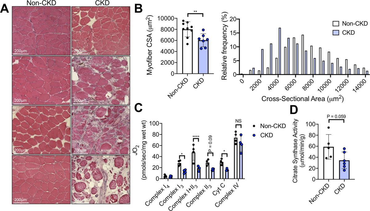 Difference Between Gas Gangrene and Necrotizing Fasciitis | Difference  Between | Gas Gangrene vs Necrotizing Fasciitis, image size:1200x683