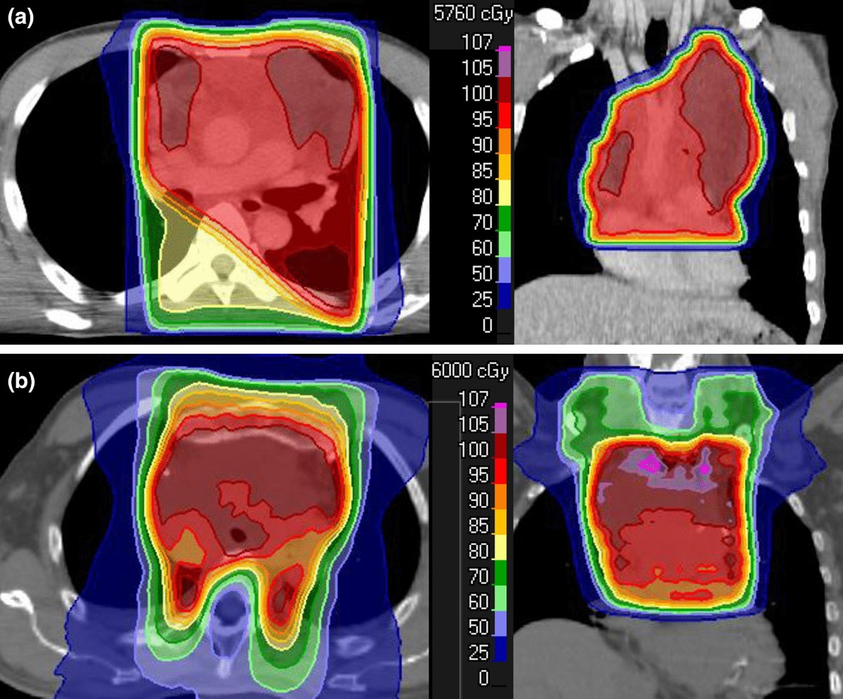 relationship-between-radiation-doses-to-heart-substructures-and-radiation-pneumonitis-in-patients-with-thymic-epithelial-tumors-scientific-reports