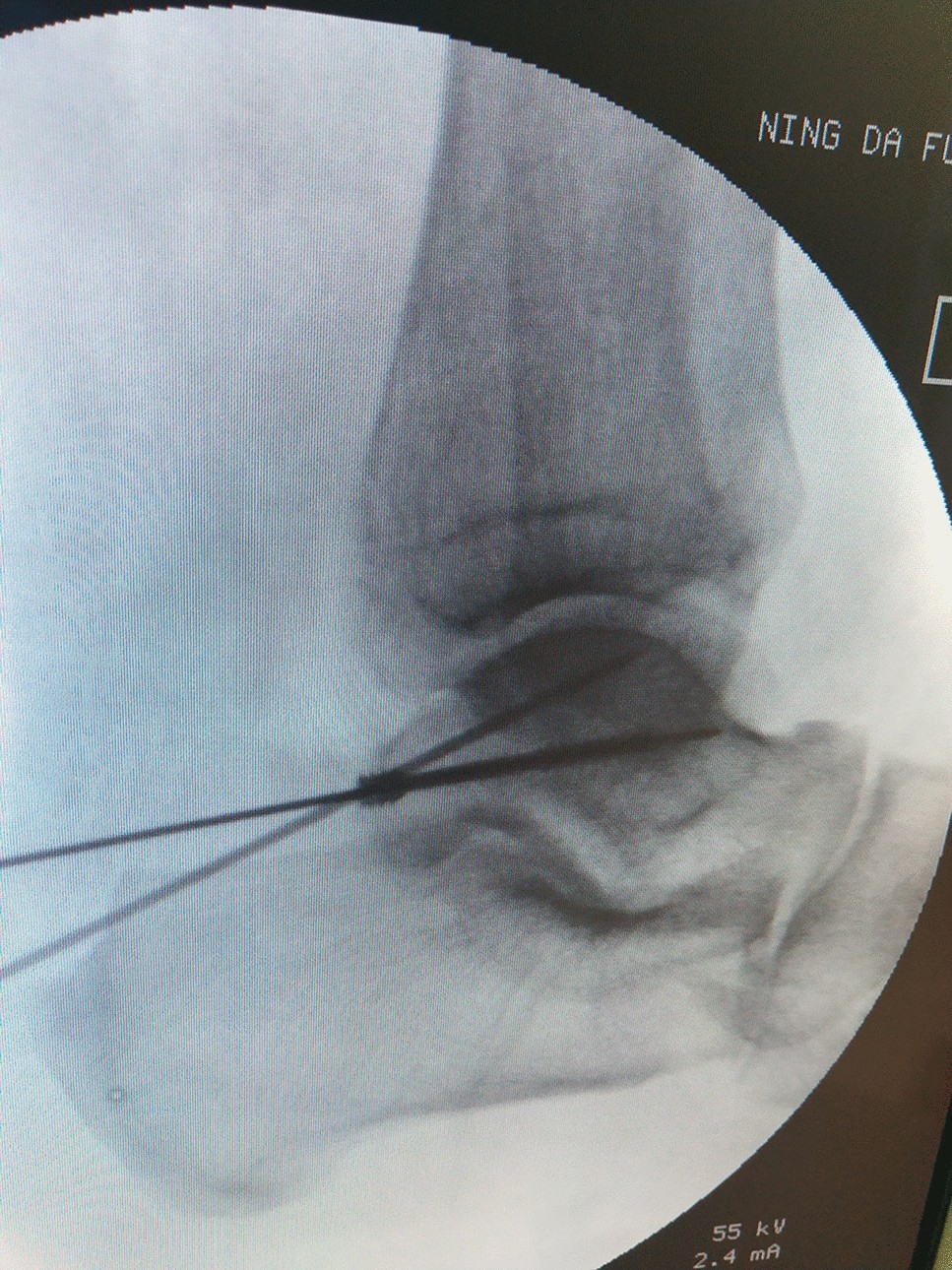 Initial assessment of treatment of talar posterior process fractures with  open reduction and percutaneous fixation | Scientific Reports