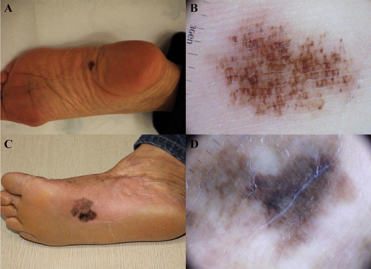 volar melanotic macules Acral lentiginous melanoma in situ: dermoscopic features and management strategy