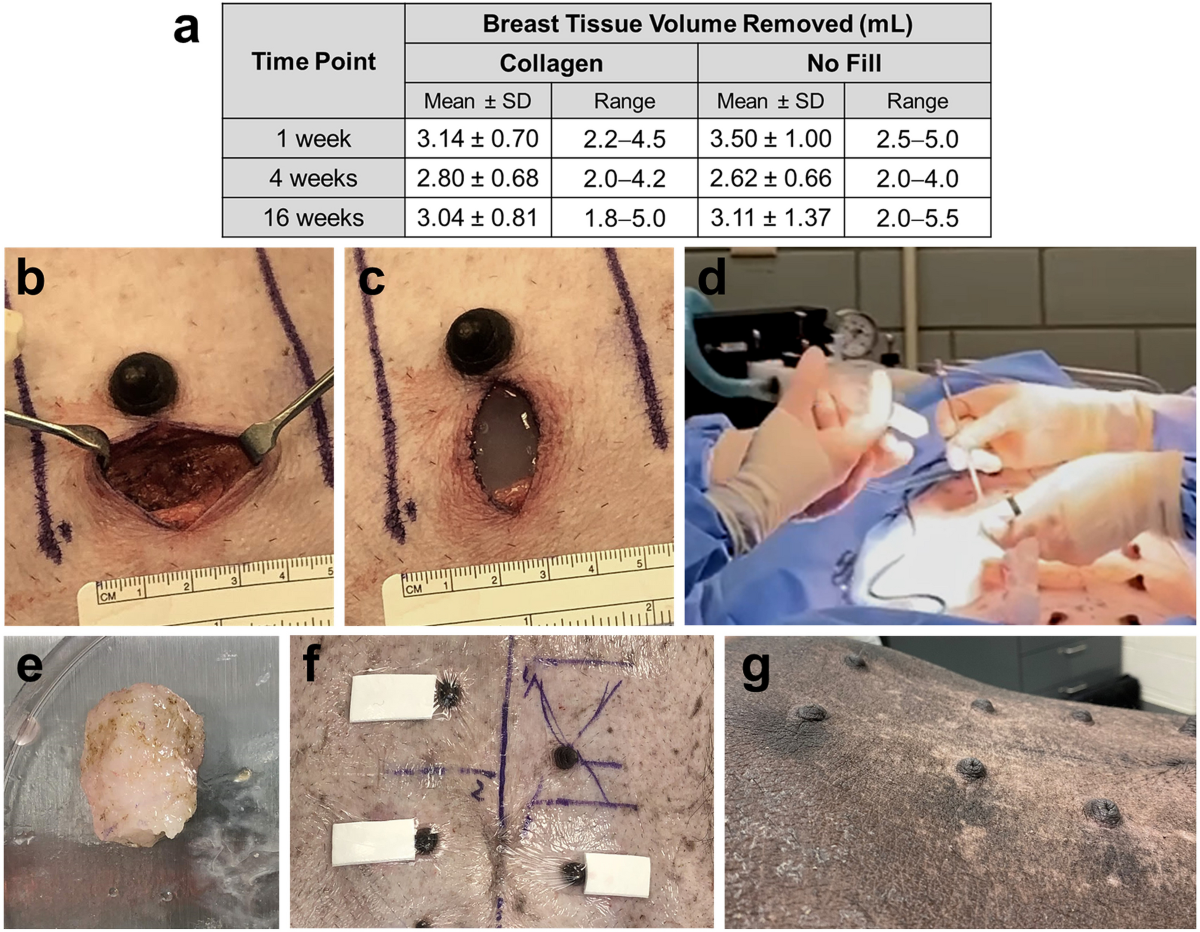 Regenerative tissue filler for breast conserving surgery and other soft  tissue restoration and reconstruction needs | Scientific Reports