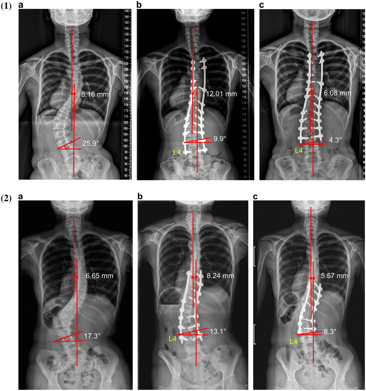 تأثير تصحيح اعوجاج العمود الفقري على الحبل الشوكي والأعصاب