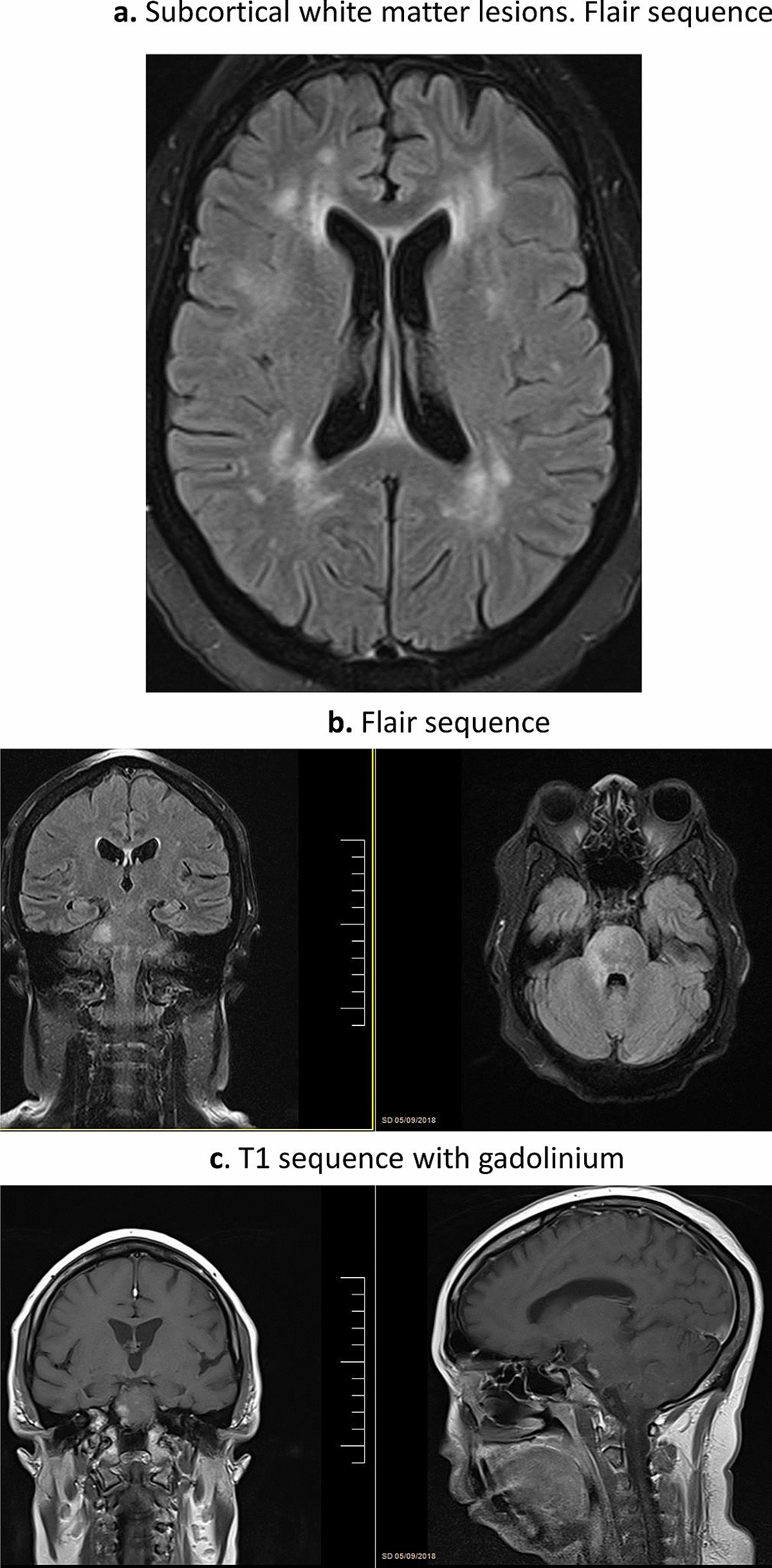 Clinical characterization and outcomes of 85 patients with neurosarcoidosis  | Scientific Reports