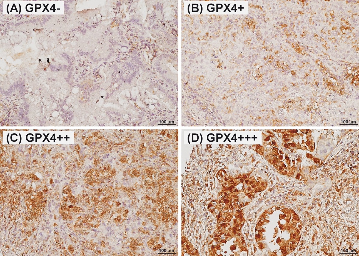 ams pearly glutathione side effects An Open-Label Case Series of Glutathione Use for Symptomatic Management in  Children with Autism Spectrum Disorder