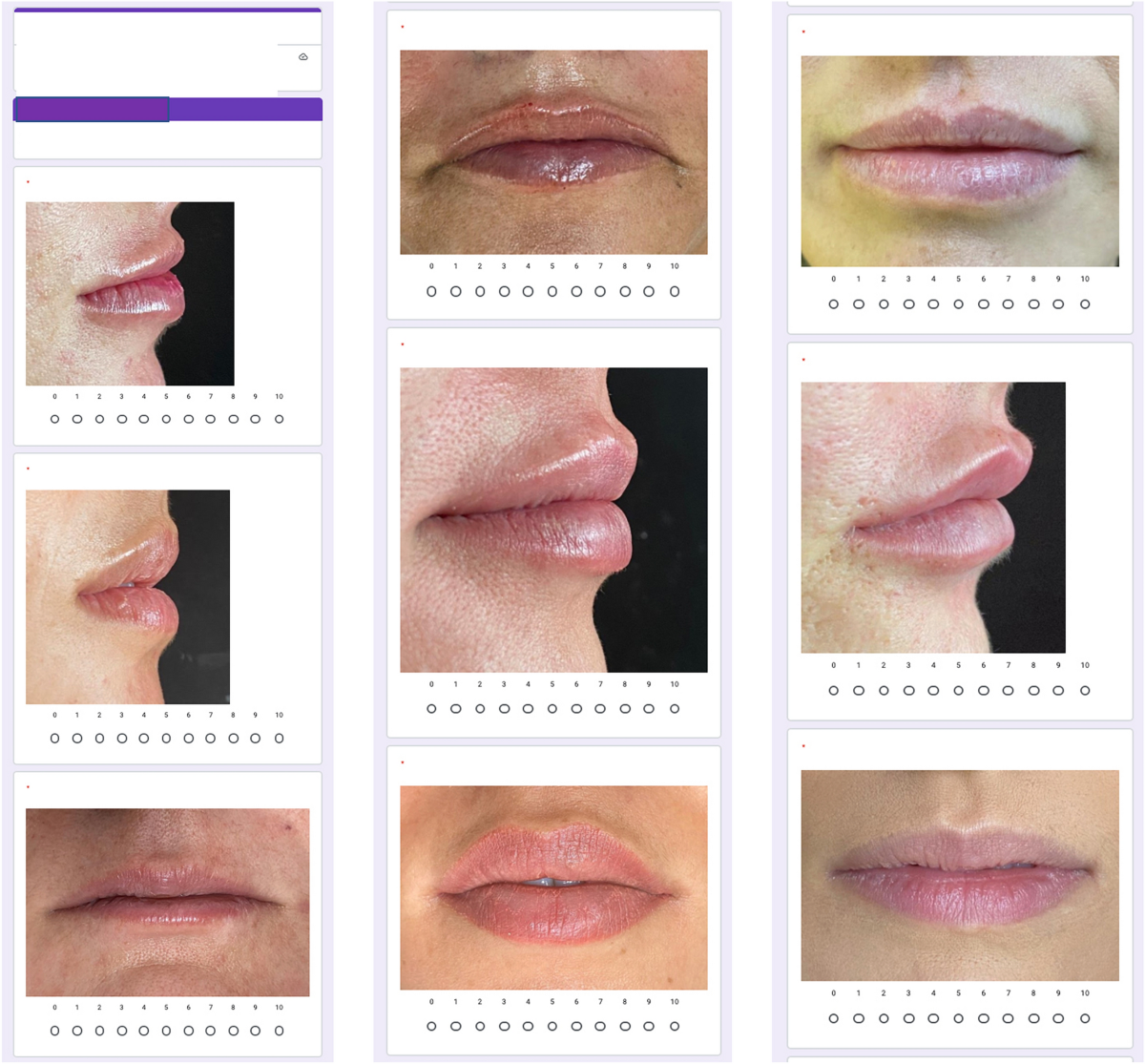 Evaluation of the attractiveness of lips with different volumes after  filling with hyaluronic acid | Scientific Reports