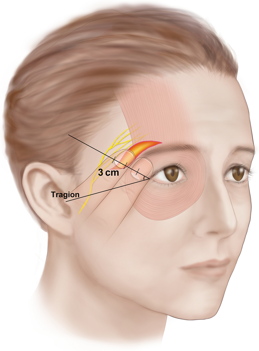 Topography of the frontal branch of the facial nerve and its clinical  implication for temporal direct browplasty | Scientific Reports, image size:826x1120