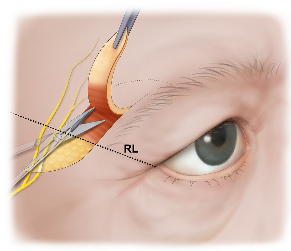 Topography of the frontal branch of the facial nerve and its clinical  implication for temporal direct browplasty | Scientific Reports, image size:967x834