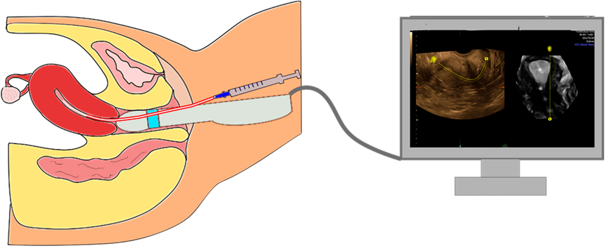 胚移植のタイミング図2