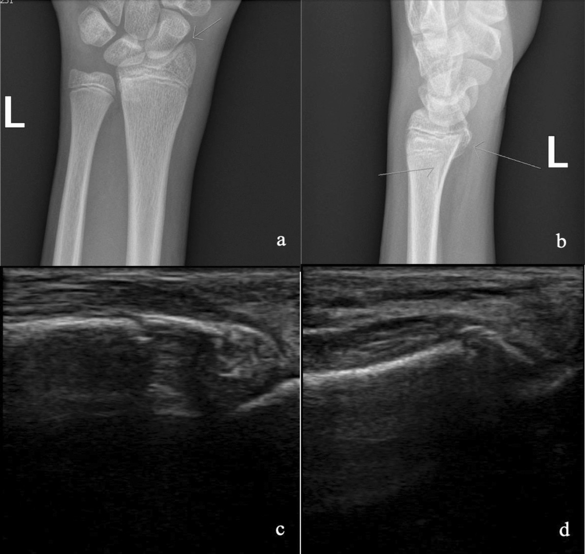 2D/3D ultrasound diagnosis of pediatric distal radius fractures by human  readers vs artificial intelligence | Scientific Reports, image size:1200x1137