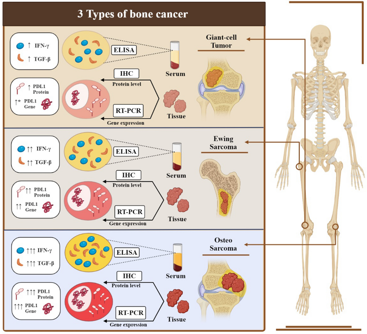 The expression changes of PD-L1 and immune response mediators are related to the severity of primary bone tumors | Scientific Reports