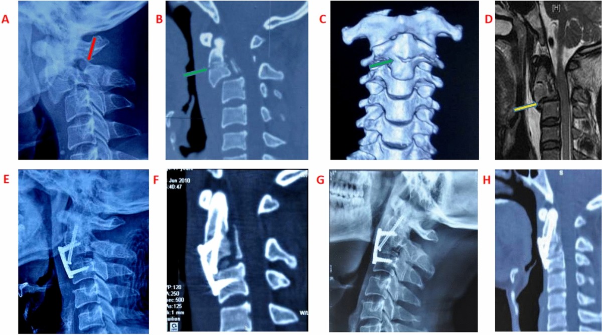 Hangman's Fracture : r/Radiology, image size:1200x668