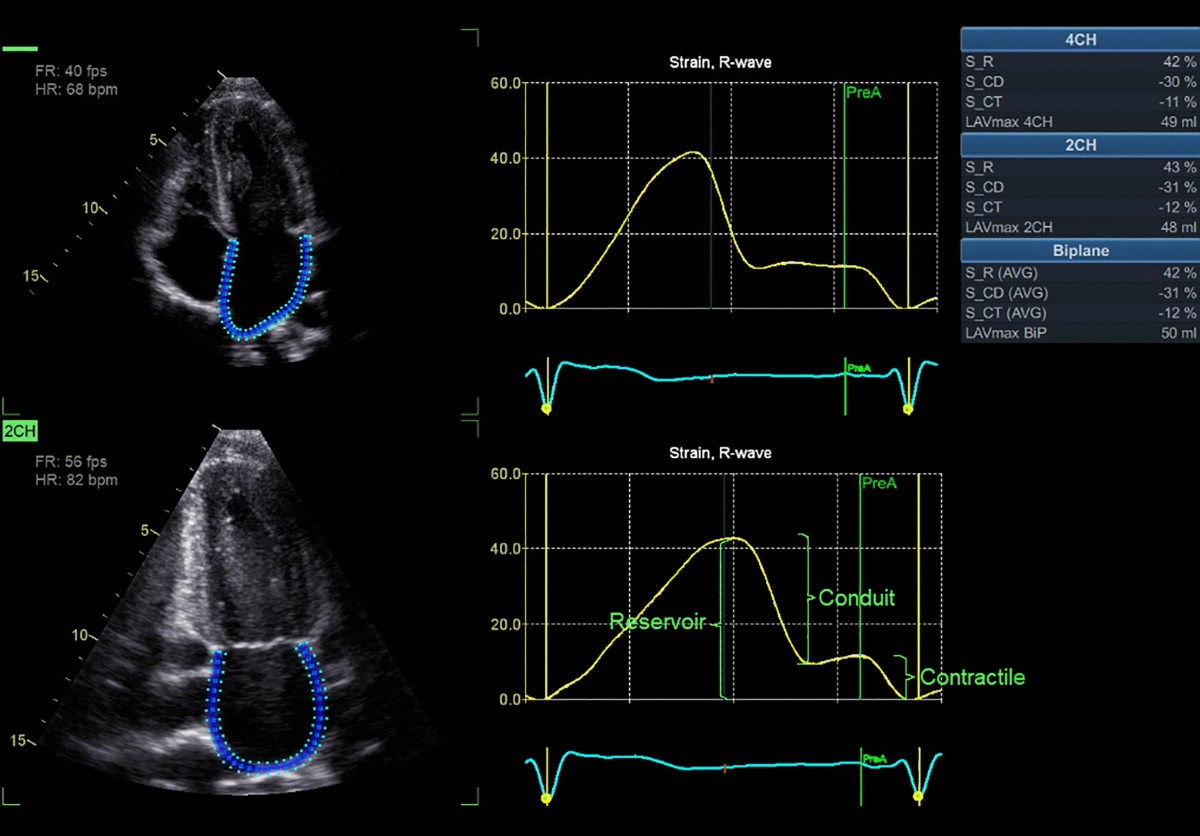 Lower left atrial function in young individuals with type 1 diabetes  mellitus compared to healthy controls: an echocardiographic study |  Scientific Reports