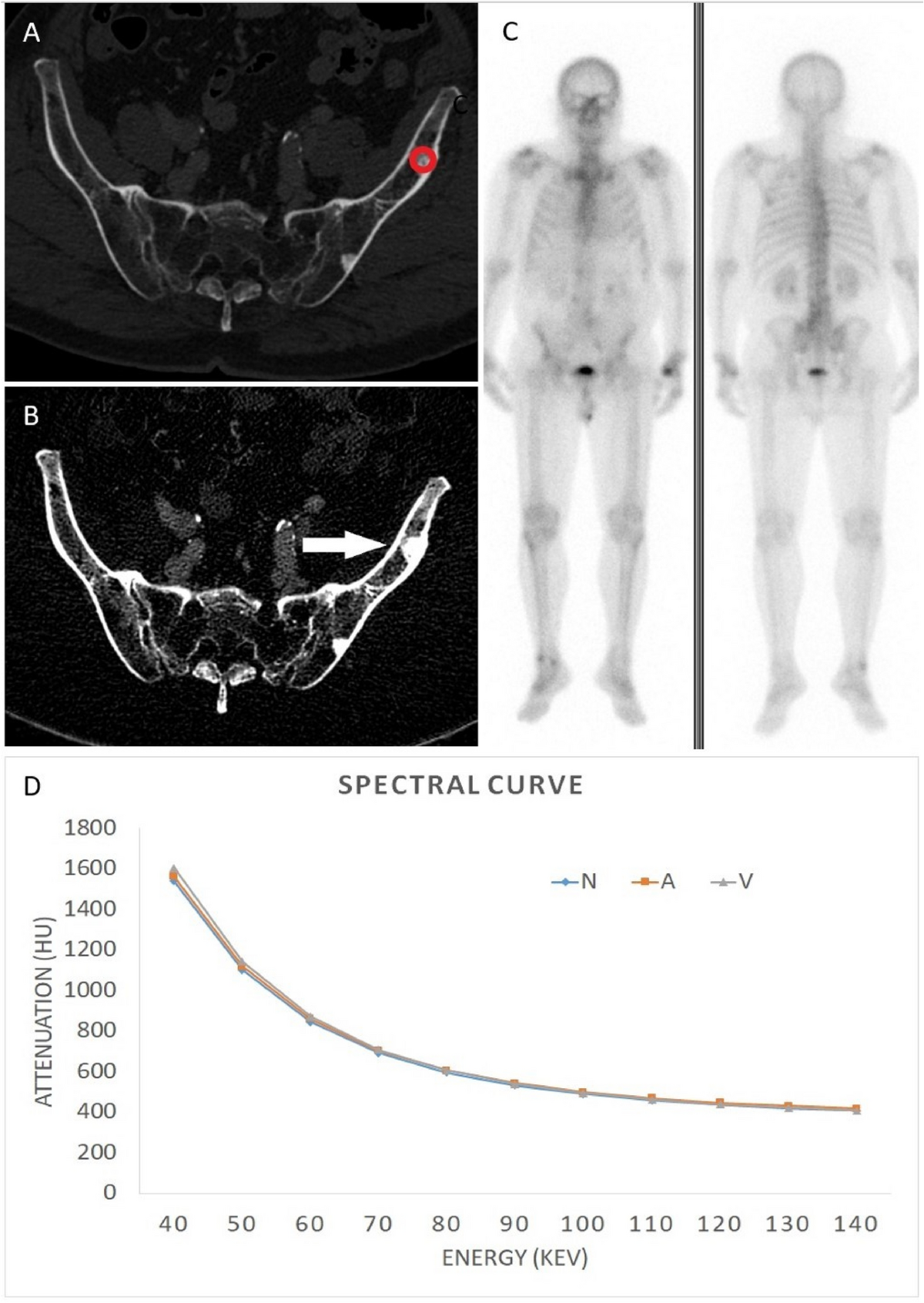 Opportunistic screening with multiphase contrast-enhanced dual-layer  spectral CT for osteoblastic lesions in prostate cancer compared with bone  scintigraphy | Scientific Reports, image size:1200x1692