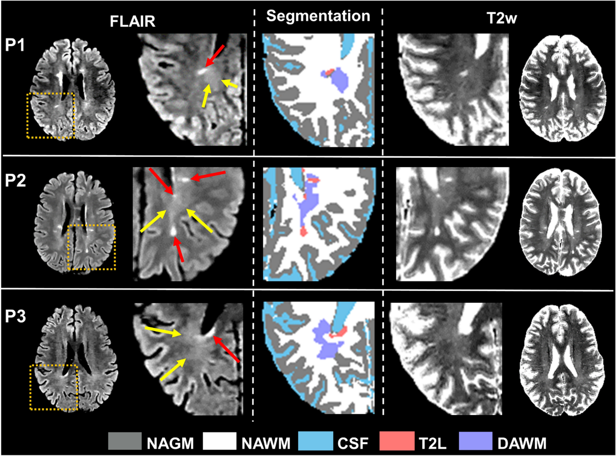 Detection of diffusely abnormal white matter in multiple sclerosis 
