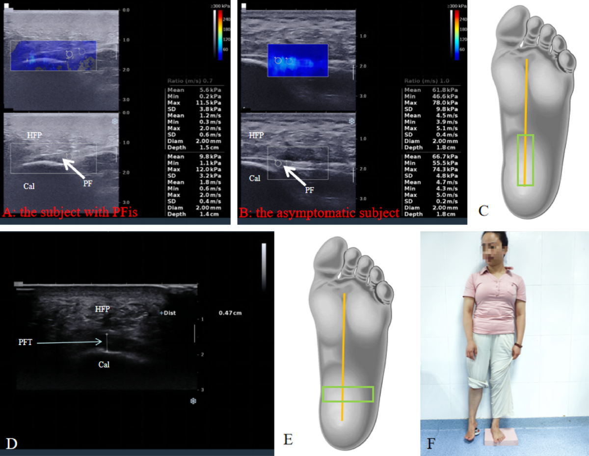 bpc 157 plantar fasciitis evidence Regional variations in fascia elasticity and their association with pain in plantar fasciitis: a cross-sectional study D-Curl