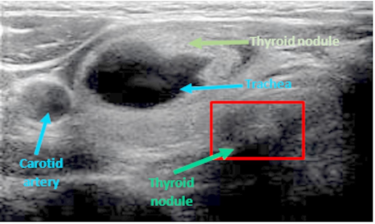 Automated thyroid nodule classification in ultrasound imaging using a hybrid vision transformer and Wasserstein GAN with gradient penalty