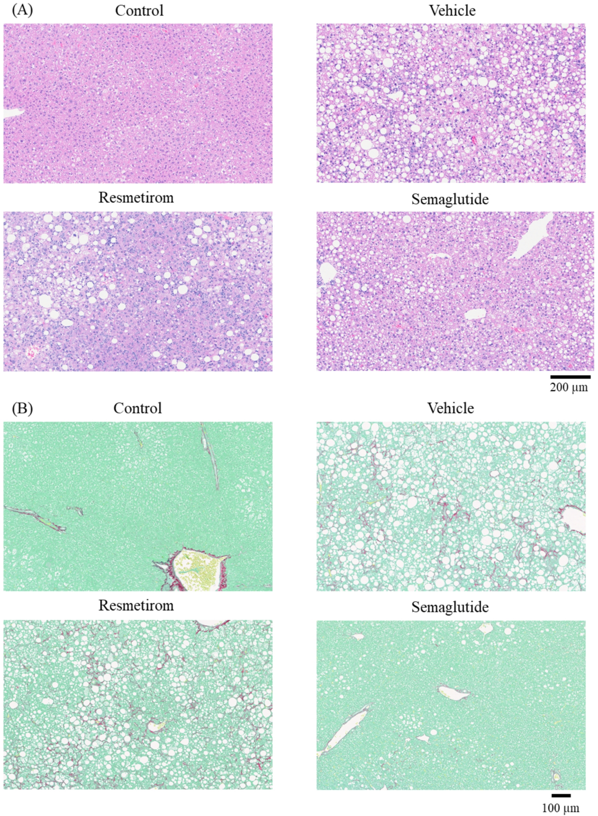 Differences between therapeutic mechanisms of resmetirom and semaglutide  against MASH in western diet-fed MC4R-knockout mice