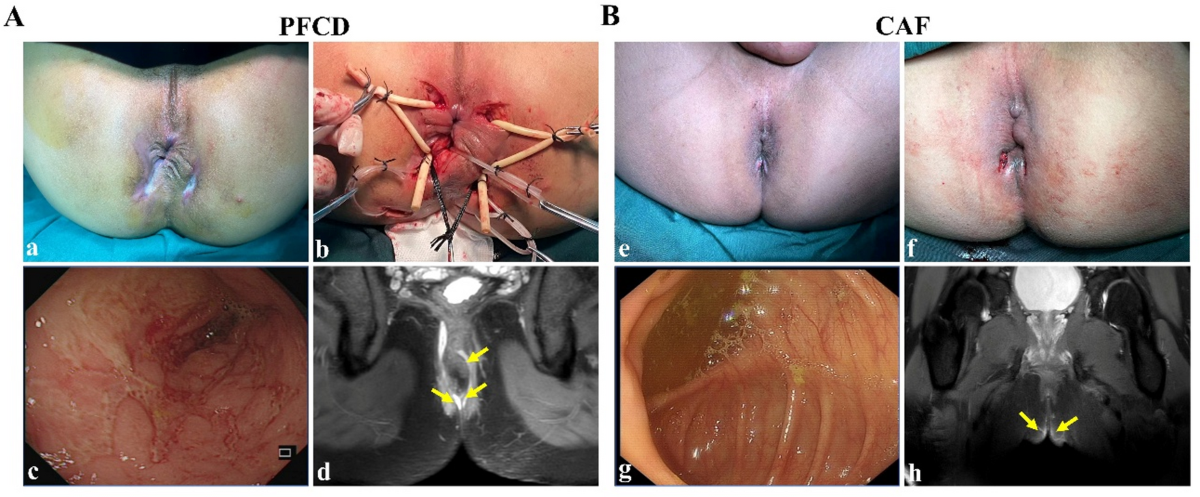 glutathione crohn's disease Metabolic profiles of amino acids in patients with crohn's disease-associated  perianal fistulas and cryptoglandular anal fistulas