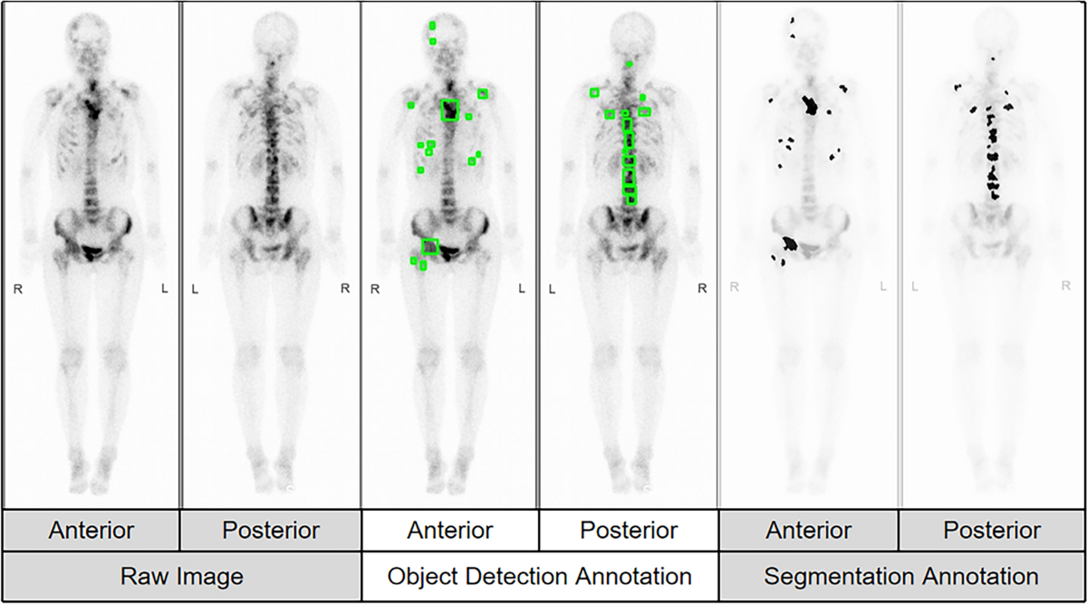 Automatic detecting multiple bone metastases in breast cancer using deep  learning based on low-resolution bone scan images | Scientific Reports, image size:1200x667